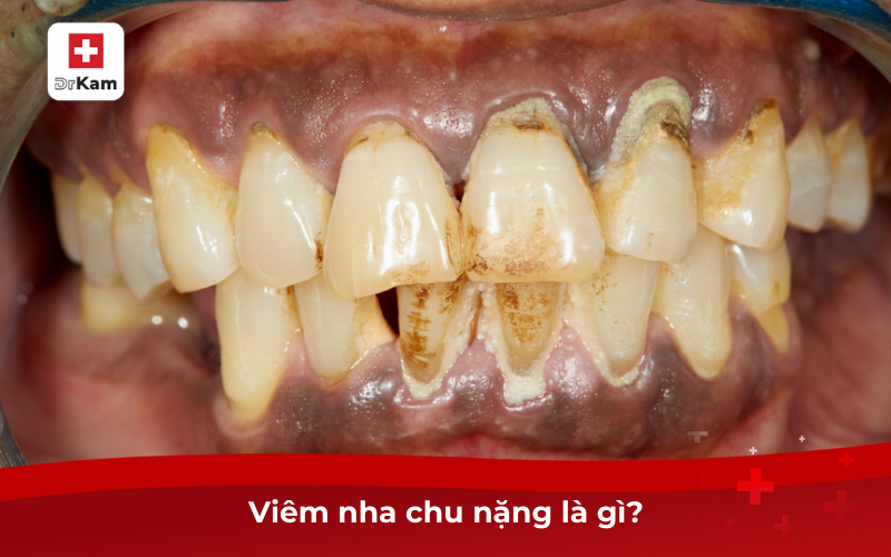 Các Phương Pháp Chữa Viêm Nha Chu Nặng Tốt Nhất Hiện Nay 6 Viêm nha chu nặng là gì?