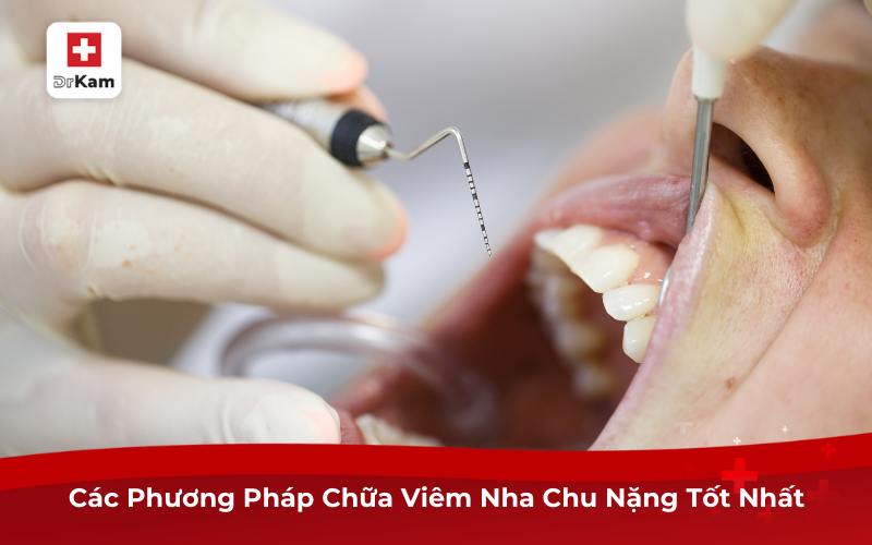 Các Phương Pháp Chữa Viêm Nha Chu Nặng Tốt Nhất Hiện Nay 7 Các Phương Pháp Chữa Viêm Nha Chu Nặng Tốt Nhất