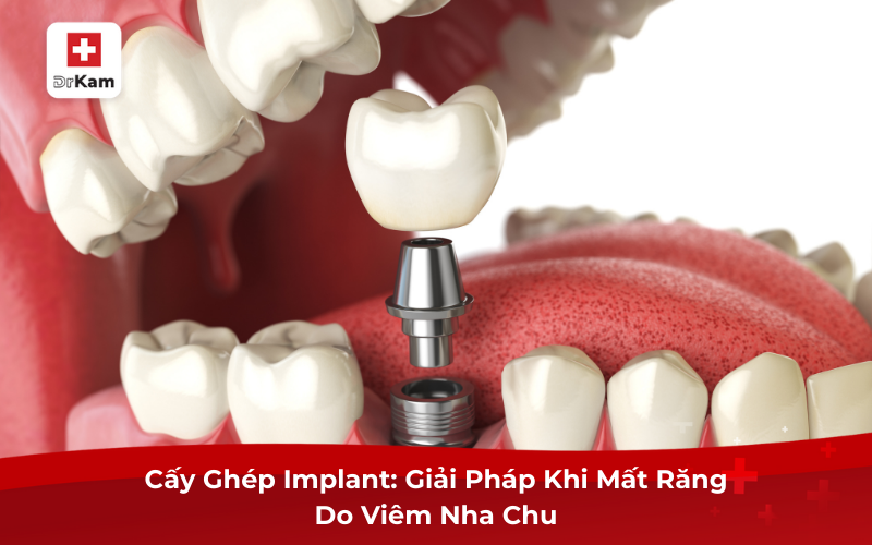 Các Phương Pháp Chữa Viêm Nha Chu Nặng Tốt Nhất Hiện Nay 8 Cấy Ghép Implant: Giải Pháp Khi Mất Răng Do Viêm Nha Chu