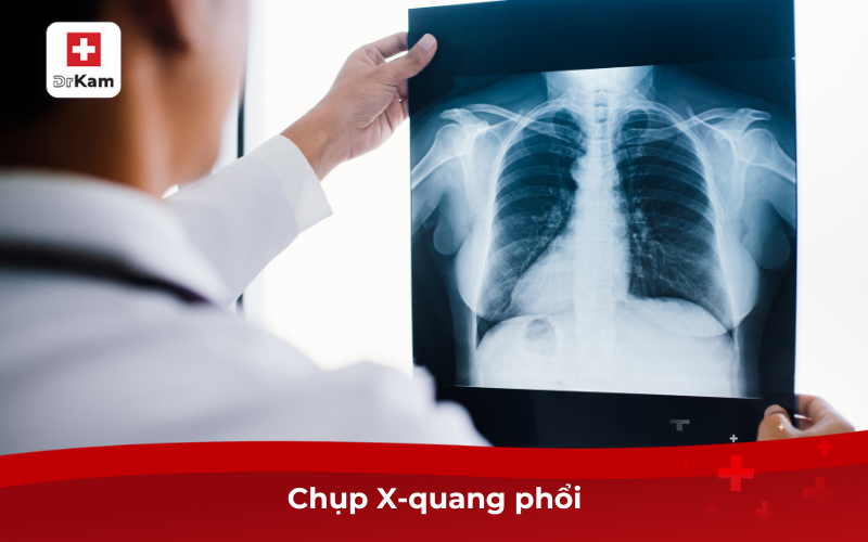 Tìm Hiểu Hội Chứng Viêm Long Đường Hô Hấp Trên 9 Chụp X-quang phổi