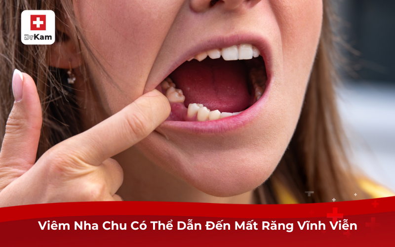 Bệnh Viêm Nha Chu Có Chữa Được Không? Chữa Thế Nào? 9 Viêm Nha Chu Có Thể Dẫn Đến Mất Răng Vĩnh Viễn