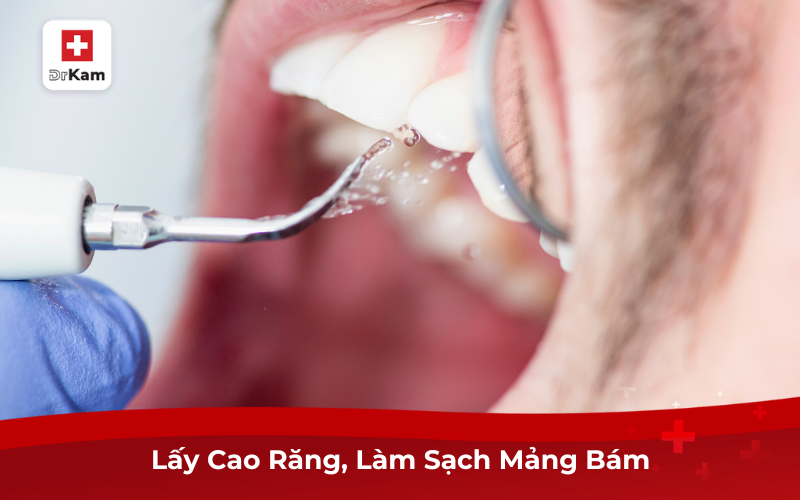 Bệnh Viêm Nha Chu Có Chữa Được Không? Chữa Thế Nào? 10 Lấy Cao Răng, Làm Sạch Mảng Bám