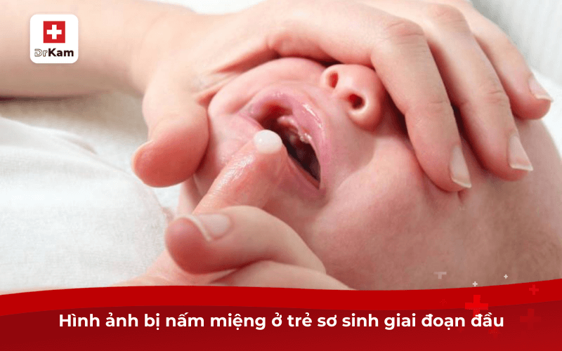 Dấu Hiệu Trẻ Bị Nấm Miệng Và Cách Điều Trị Hiệu Quả 10 Hình ảnh bị nấm miệng ở trẻ sơ sinh giai đoạn đầu