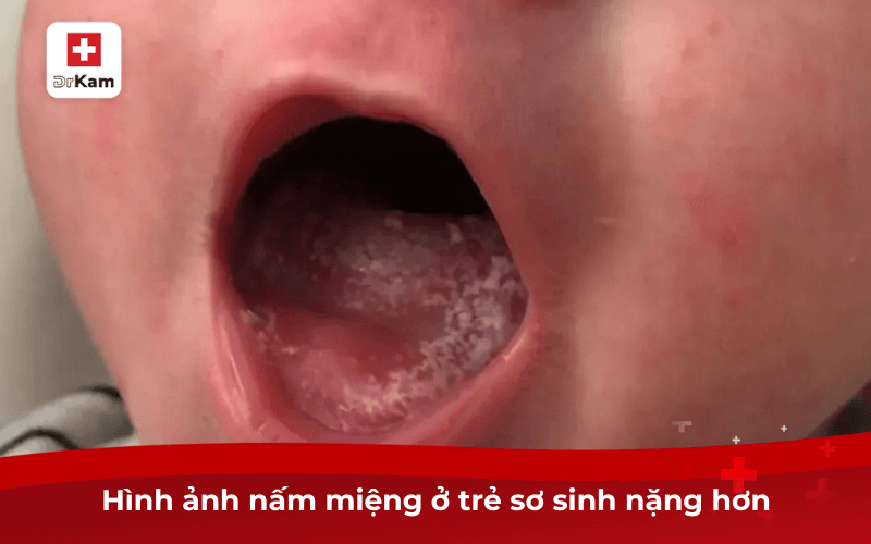 Dấu Hiệu Trẻ Bị Nấm Miệng Và Cách Điều Trị Hiệu Quả 11 Hình ảnh nấm miệng ở trẻ sơ sinh nặng hơn
