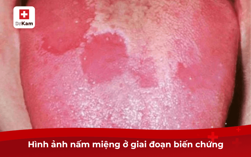 Dấu Hiệu Trẻ Bị Nấm Miệng Và Cách Điều Trị Hiệu Quả 12 Hình ảnh nấm miệng ở giai đoạn biến chứng