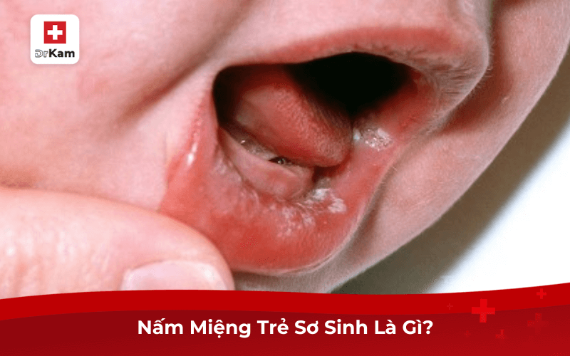Phòng Ngừa Và Điều Trị Dứt Điểm Nấm Miệng Trẻ Sơ Sinh 6 Nấm Miệng Trẻ Sơ Sinh Là Gì?