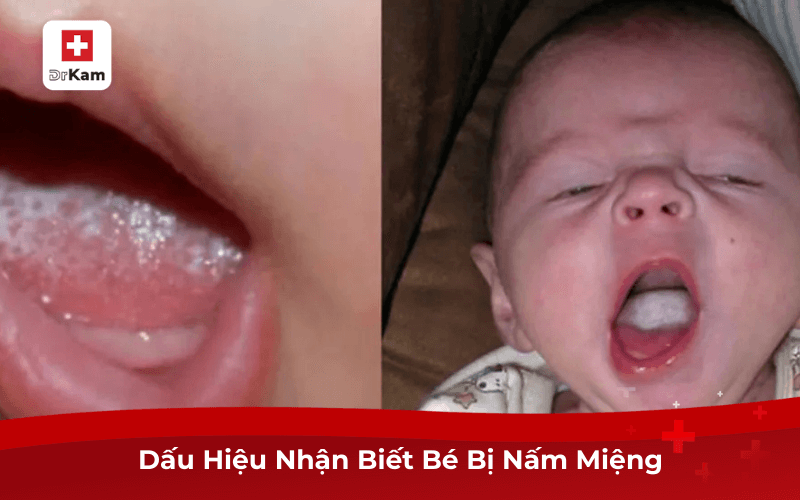 Dấu Hiệu Nhận Biết Bé Bị Nấm Miệng