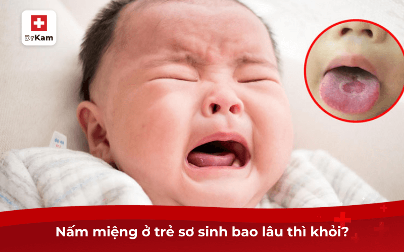 Nấm miệng ở trẻ sơ sinh bao lâu thì khỏi?