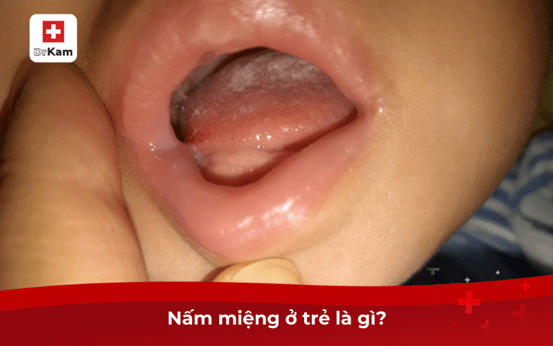 5 mẹo trị nấm miệng cho trẻ hiệu quả tại nhà 6 Nấm miệng ở trẻ là gì?