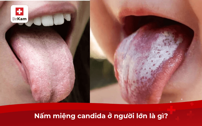 Nấm miệng candida ở người lớn là gì?