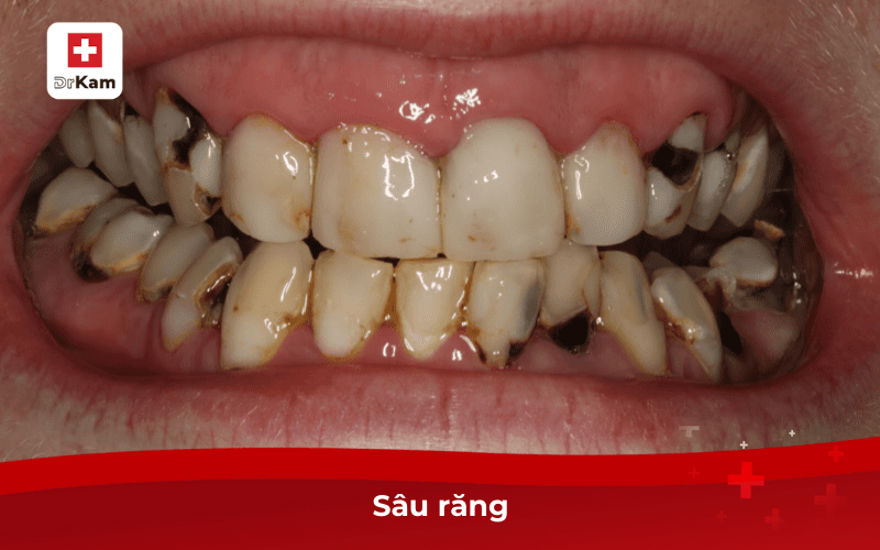 10 bệnh răng miệng thường gặp nhất và cách phòng ngừa 7 Sâu răng