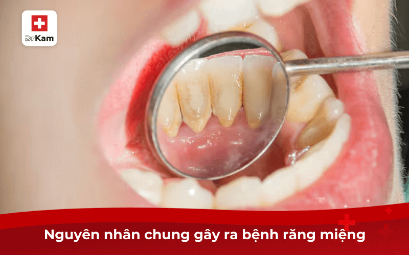 10 bệnh răng miệng thường gặp nhất và cách phòng ngừa 6 Nguyên nhân chung gây ra bệnh răng miệng
