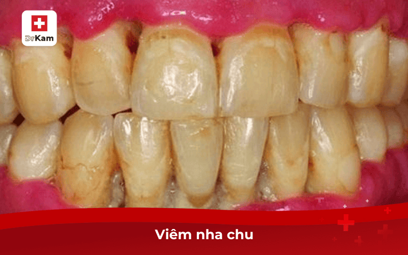 10 bệnh răng miệng thường gặp nhất và cách phòng ngừa 8 Viêm nha chu