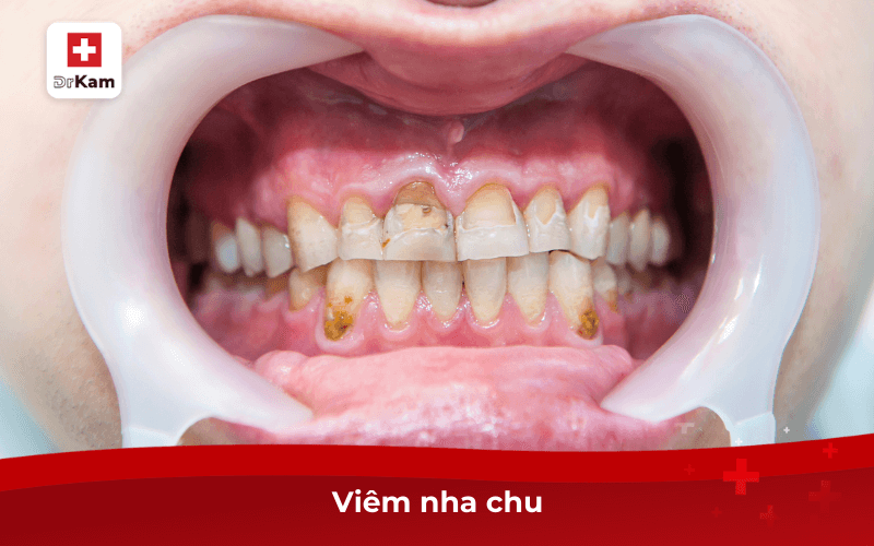 Các bệnh răng miệng nguy hiểm dễ gặp nhất cần phát hiện sớm 7 Viêm nha chu