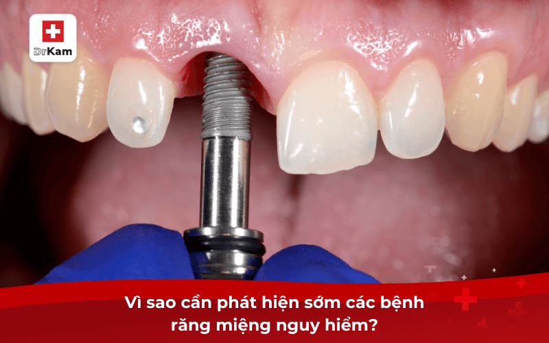 Các bệnh răng miệng nguy hiểm dễ gặp nhất cần phát hiện sớm 6 Vì sao cần phát hiện sớm các bệnh răng miệng nguy hiểm?