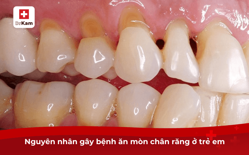 Nguyên nhân gây bệnh ăn mòn chân răng ở trẻ em