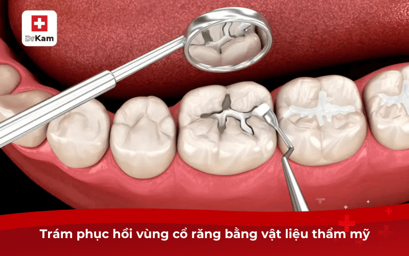 Trám phục hồi vùng cổ răng bằng vật liệu thẩm mỹ