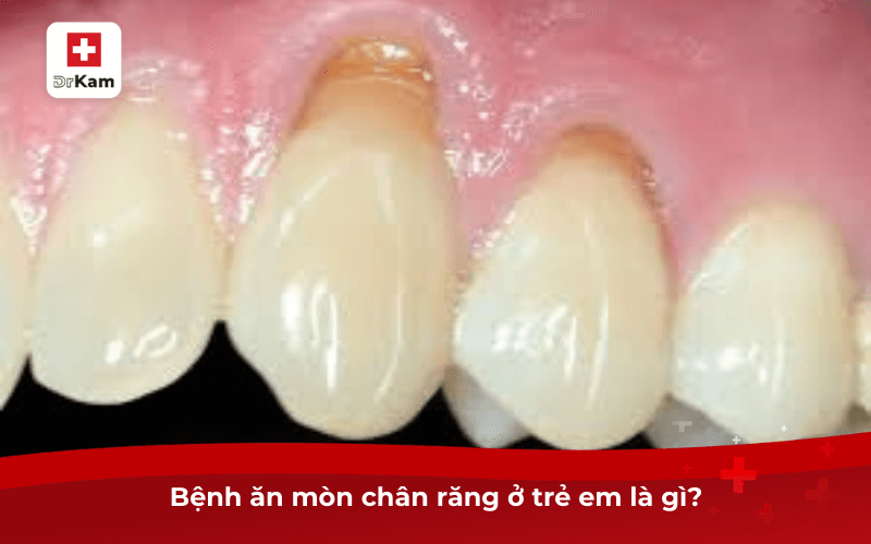 Bệnh ăn mòn chân răng ở trẻ em là gì?