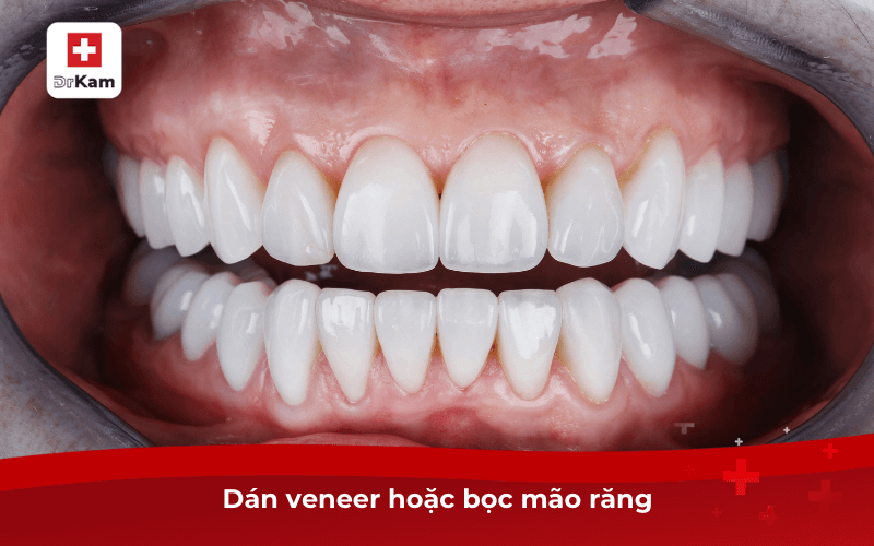 Dán veneer hoặc bọc mão răng