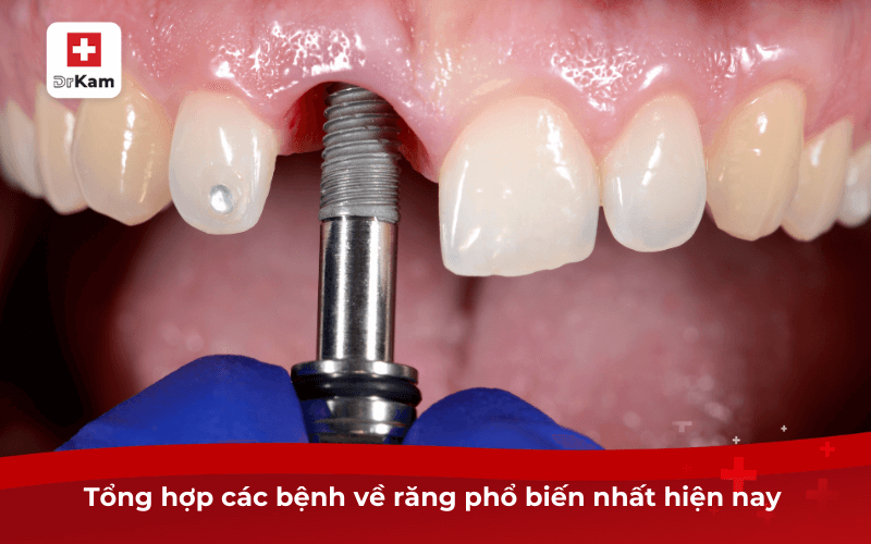 Tổng hợp các bệnh về răng phổ biến nhất hiện nay 