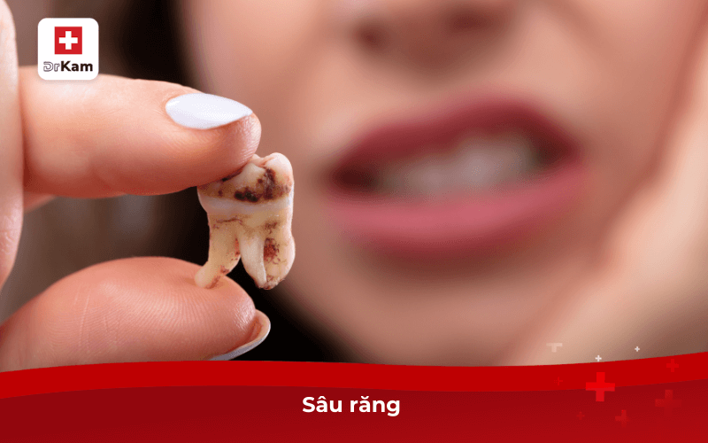 Sâu răng 