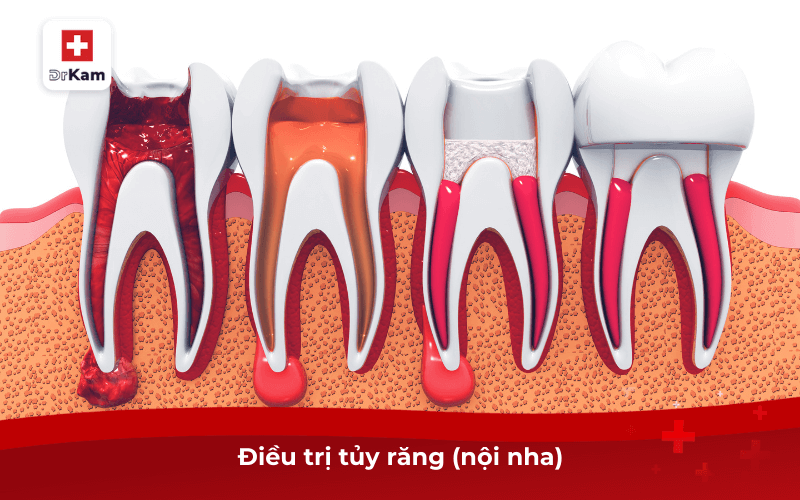 Điều trị tủy răng (nội nha)