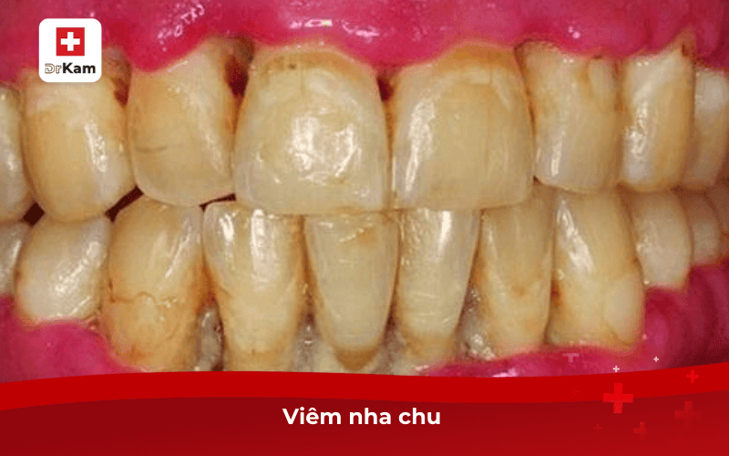 Viêm nha chu 