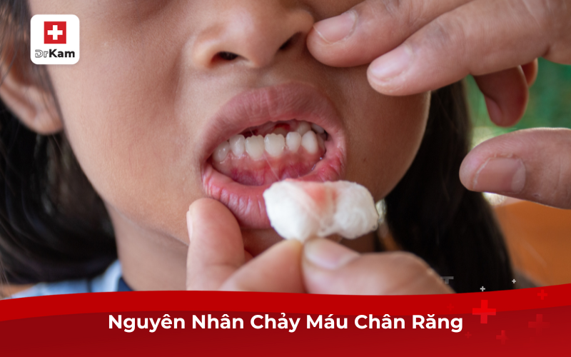 Chảy máu chân răng ung thư: Dấu hiệu không thể xem nhẹ 7 Nguyên nhân chảy máu chân răng