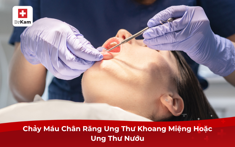 Chảy máu chân răng ung thư: Dấu hiệu không thể xem nhẹ 9 Chảy máu chân răng ung thư khoang miệng hoặc ung thư nướu