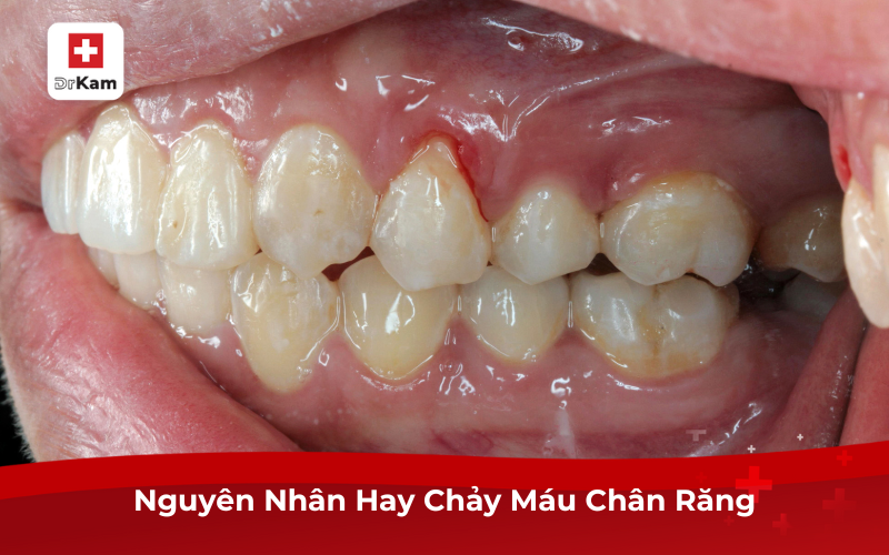 Nguyên nhân hay chảy máu chân răng, chữa trị, phòng ngừa 7 Nguyên nhân hay chảy máu chân răng