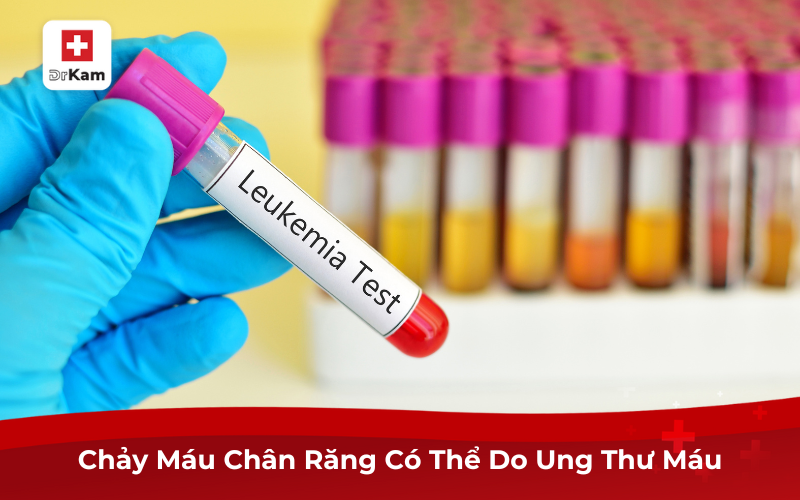 Chảy máu chân răng ung thư: Dấu hiệu không thể xem nhẹ 8 Chảy máu chân răng có thể do ung thư máu