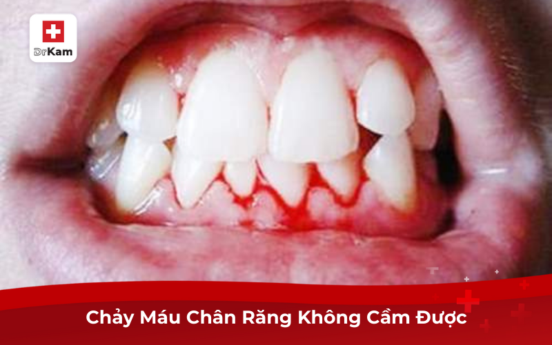 Nguyên Nhân Chảy Máu Chân Răng Không Cầm Được Và Cách Phòng Ngừa 6 Chảy máu chân răng không cầm được