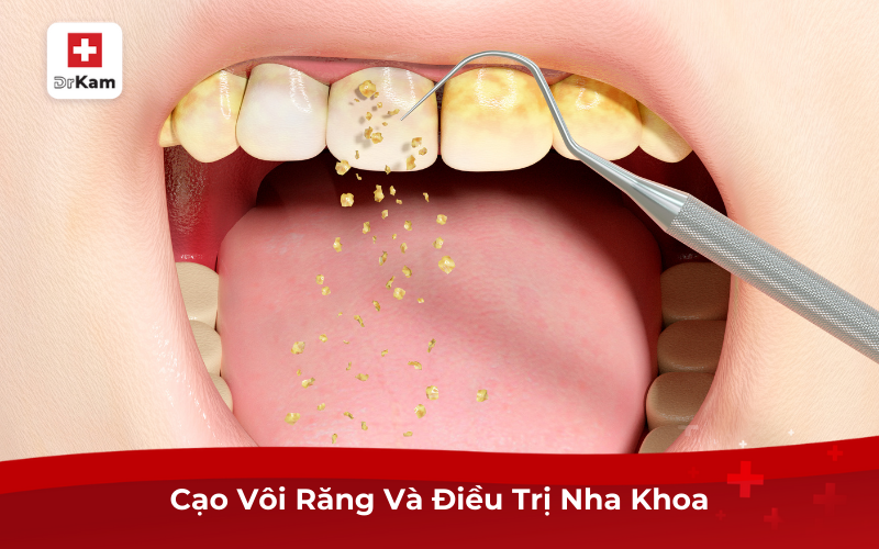 Cạo Vôi Răng Và Điều Trị Nha Khoa