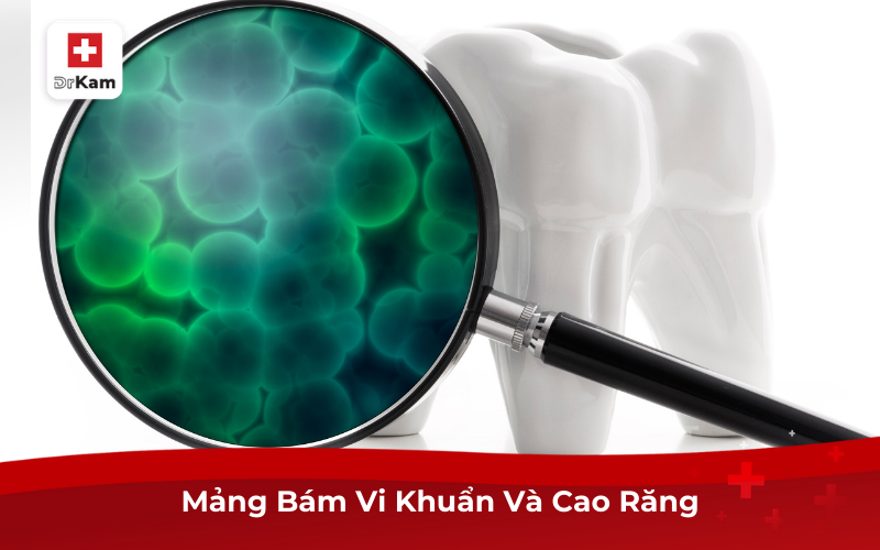Mảng Bám Vi Khuẩn Và Cao Răng