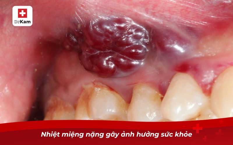 Những điều cần biết khi bị nhiệt miệng nặng 8 Nhiệt miệng nặng gây ảnh hưởng sức khỏe