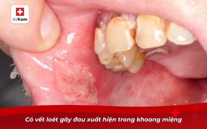 Những điều cần biết khi bị nhiệt miệng nặng 9 Có vết loét gây đau xuất hiện trong khoang miệng