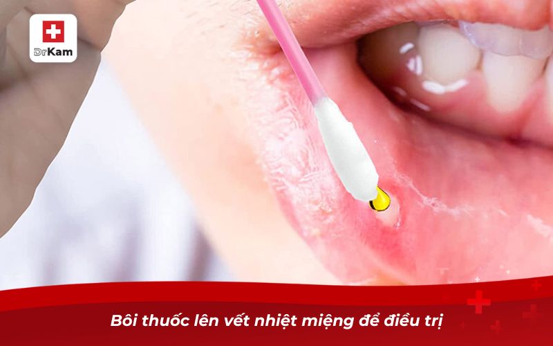 Những điều cần biết khi bị nhiệt miệng nặng 12 Bôi thuốc lên vết nhiệt miệng để điều trị