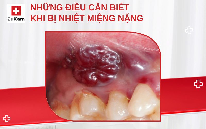bi nhiet mieng nang thumbnail