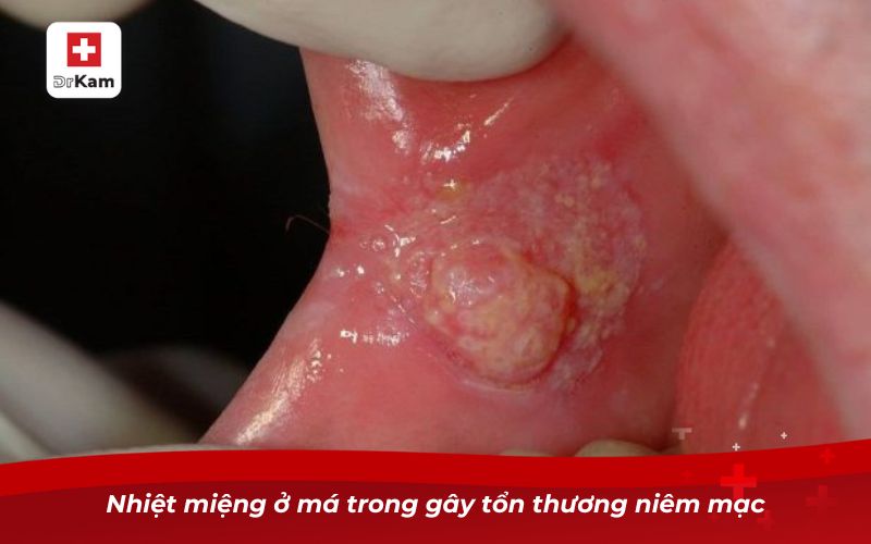 Bị nhiệt miệng ở má trong và cách chữa trị hiệu quả 8 Nhiệt miệng ở má trong gây tổn thương niêm mạc