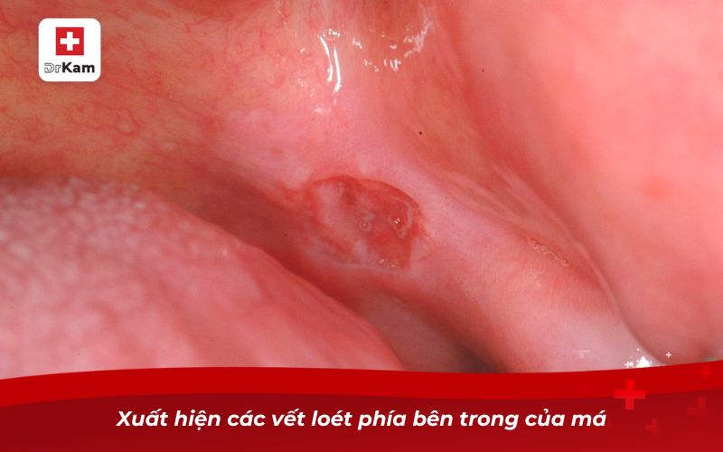 Bị nhiệt miệng ở má trong và cách chữa trị hiệu quả 10 Xuất hiện các vết loét phía bên trong của má