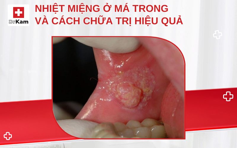 bi nhiet mieng o ma trong thumbnail