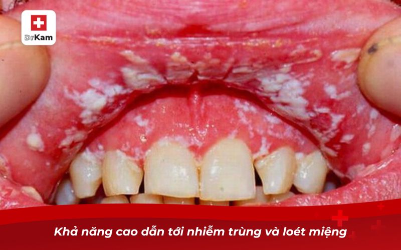 Bị nhiệt miệng quan hệ bằng miệng có sao không? 8 Khả năng cao dẫn tới nhiễm trùng và loét miệng