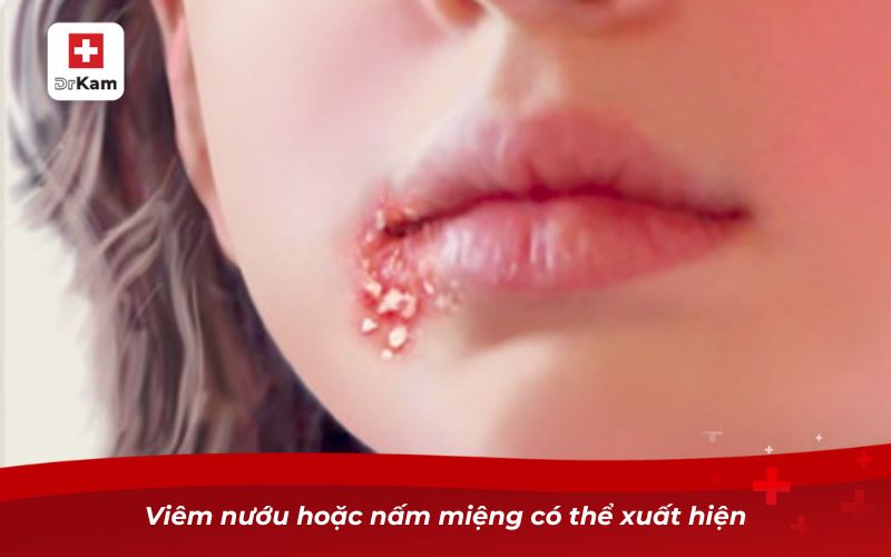 Bị nhiệt miệng quan hệ bằng miệng có sao không? 10 Viêm nướu hoặc nấm miệng có thể xuất hiện