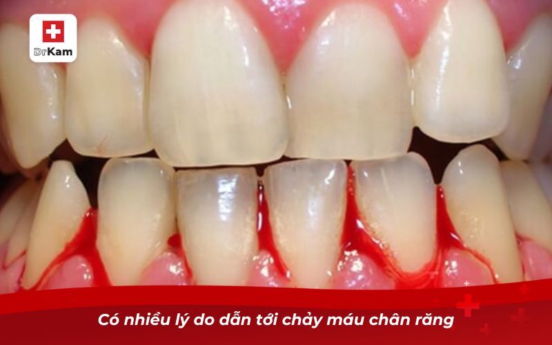 Có nhiều lý do dẫn tới chảy máu chân răng