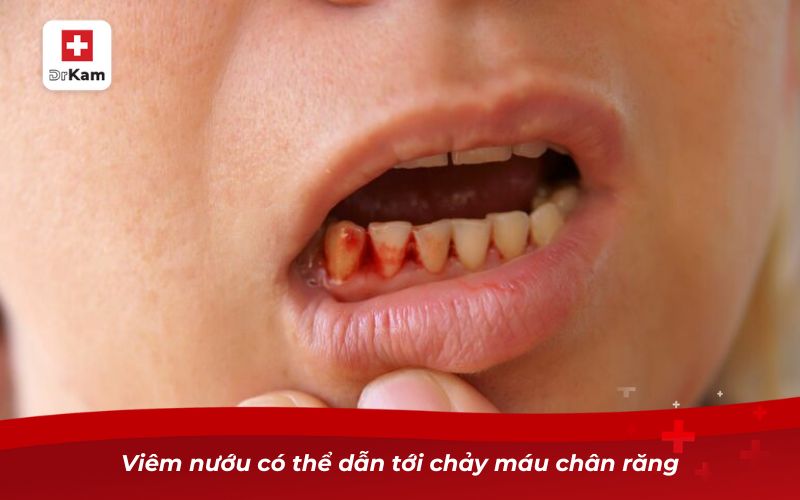 Viêm nướu có thể dẫn tới chảy máu chân răng