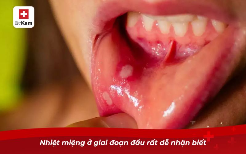 Nhận diện hình ảnh bị nhiệt miệng qua từng giai đoạn 6 Nhiệt miệng ở giai đoạn đầu rất dễ nhận biết