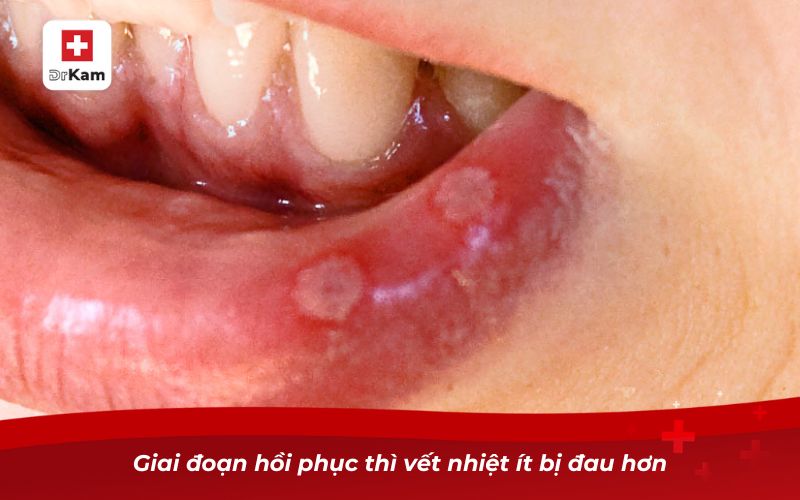 Nhận diện hình ảnh bị nhiệt miệng qua từng giai đoạn 7 Giai đoạn hồi phục thì vết nhiệt ít bị đau hơn