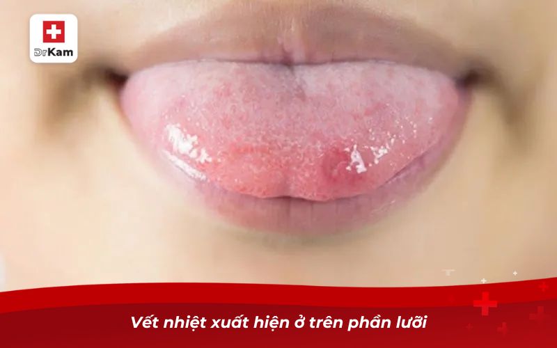 Nhận diện hình ảnh bị nhiệt miệng qua từng giai đoạn 8 Vết nhiệt xuất hiện ở trên phần lưỡi