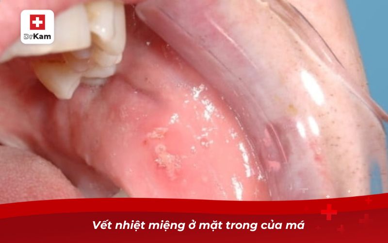 Nhận diện hình ảnh bị nhiệt miệng qua từng giai đoạn 9 Vết nhiệt miệng ở mặt trong của má