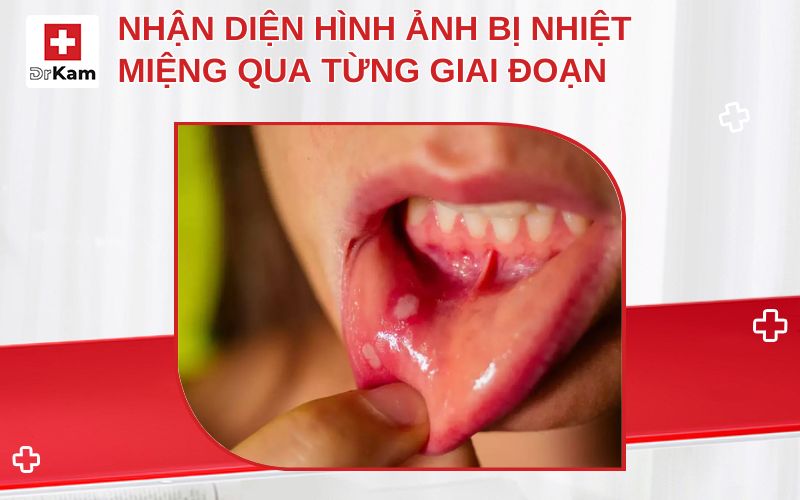 hinh anh bi nhiet mieng thumbnail